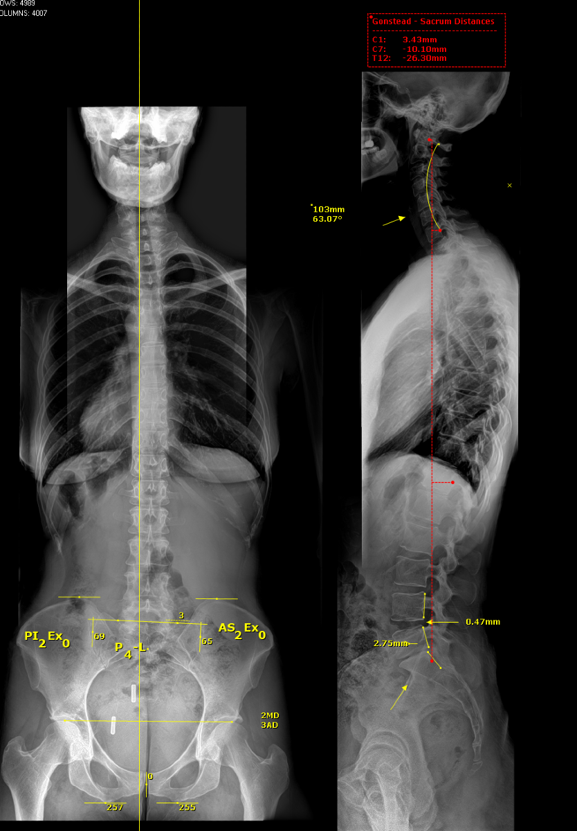 Follow-Up Xray. Less Posterior Translation of L5 and Slightly more Disc space at L5/S1. Also note better curve alignment in Cervical Spine.