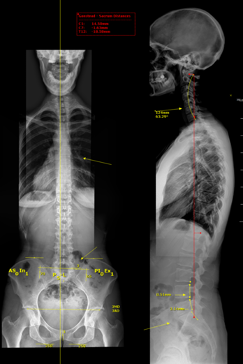 Initial Xray. Note 3.14mm Posterior Translation of L5 and Lost Disc space at L5/S1. Also note early disc degeneration at C5/6.